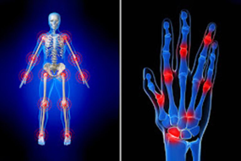 “RHEUMATOID ARTHRITIS and PAIN” Siddha Healsgfgf