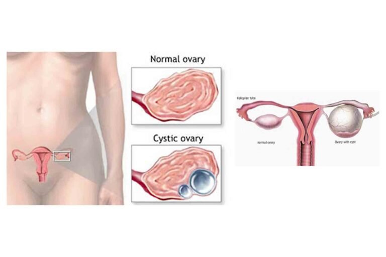 SIDDHA TREATMENT FOR “OVARIAN CYSTS” – WONDERFUL CURE