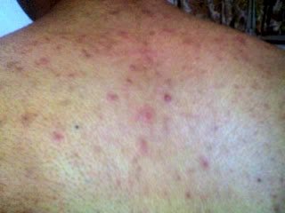 “SEBORRHEIC DERMATITIS”-Photos Before and After SIDDHA TREATMENT