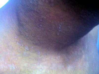 TINEA INFECTION & SIDDHA CURE