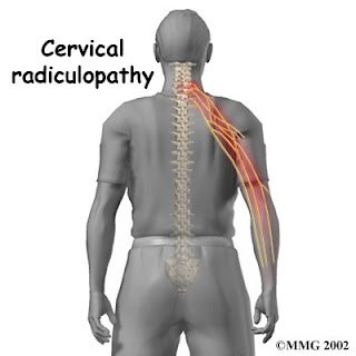 CERVICAL SPONDYLOSIS “SIDDHA-HEALS”