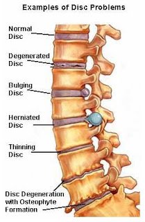 LOW BACK PAIN AND SCIATICA…. SIDDHA CURES…!!!