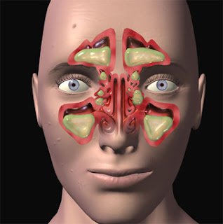 SUCCESSFUL TREATMENT FOR “SINUSITIS” IN SIDDHA MEDICINE